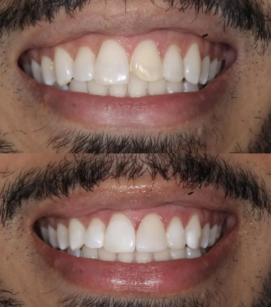 Depo resina pronto 1